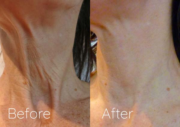 Before & After Laser Skin Rejuvenation
