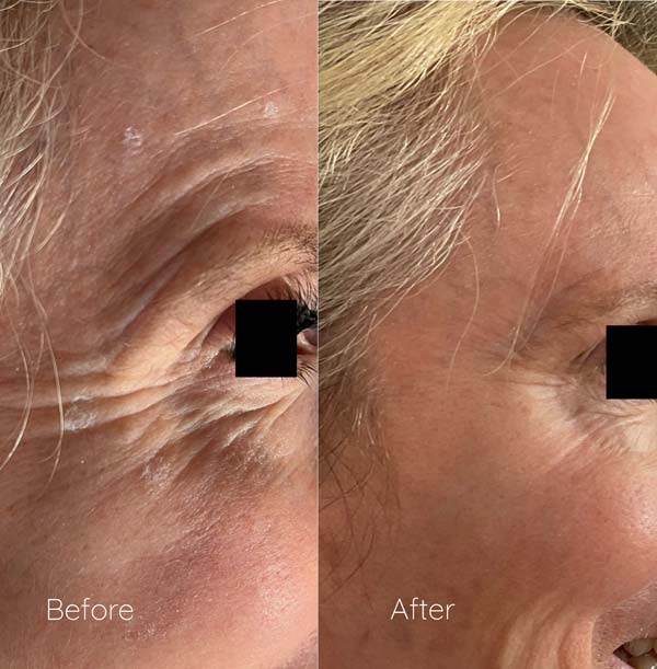 Before & After Microneedling in Whitefish - Patient Results