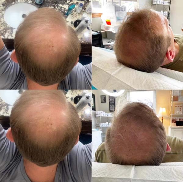 Before & After PRF Hair Loss Treatment - One Treatment