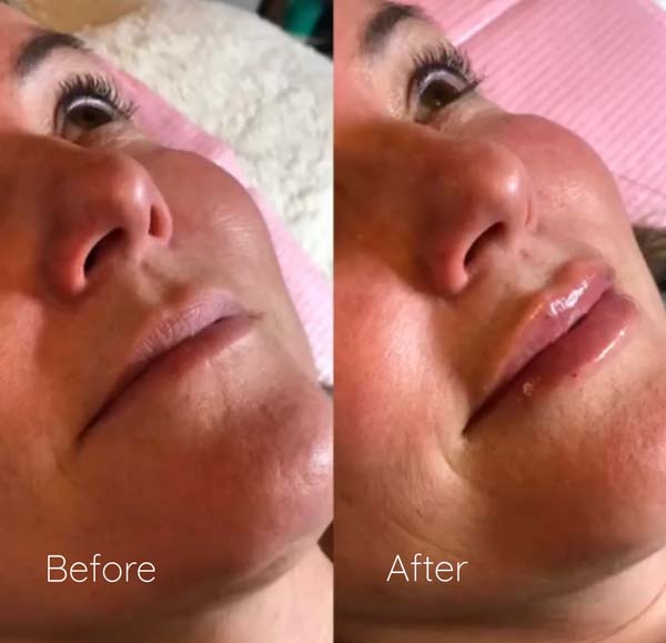 Paitent in Whitefish with Lip Filler Before & After